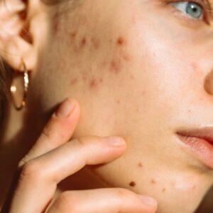 What is a permanent treatment for acne scars in Islamabad
