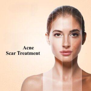 What’s the Best Acne Scar Treatment for Sensitive Skin in Islamabad