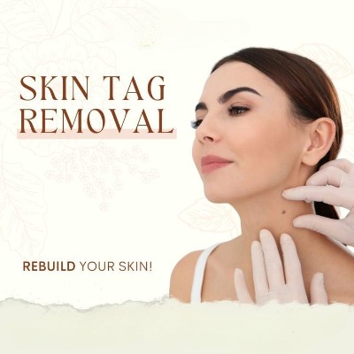 Who Offers the Best Skin Tag Removal Services in Islamabad