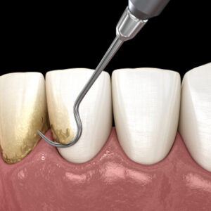 Can I brush my teeth after deep scaling