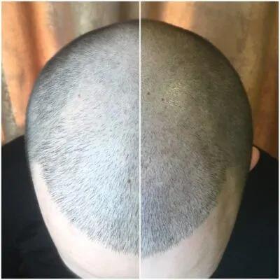 Can I wear a hat after scalp micropigmentation