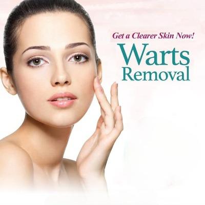 Do Dermatologists Recommend Warts Removal in Islamabad