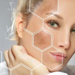 Does Melasma Go Away Without Treatment