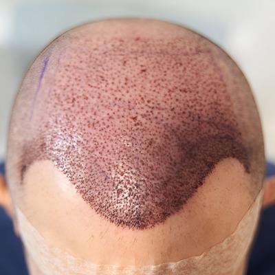 FUT hair transplant Islamabad,