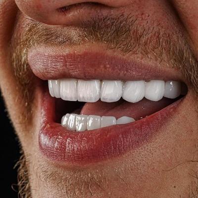 Hollywood smile makeover near me