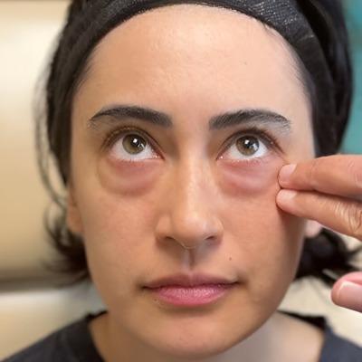 How do they remove fat from under the eyes