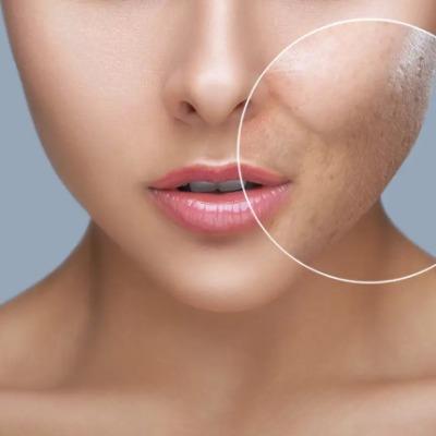 How long does CO₂ laser scar removal take to heal