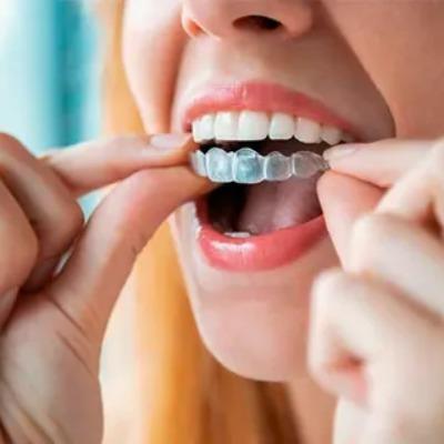 Teeth Aligners In Islamabad