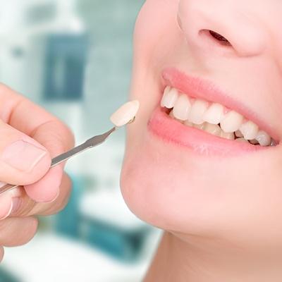 Teeth Composite Bonding Near Me