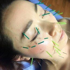 What Can Happen if Acupuncture is Done Wrong