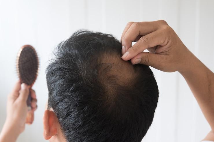 What Causes Hair Fall​