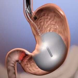 What should I Expect After an Allurion Balloon