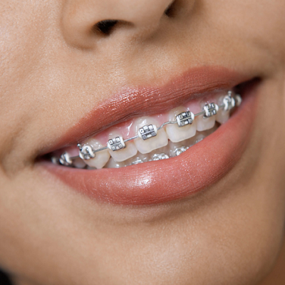 dental brace in islamabad pakistan