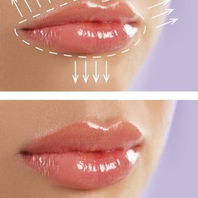 5 things to Know before first Time lip fillers
