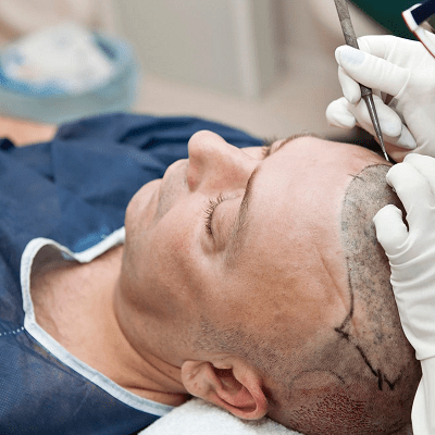 Best Hair Restoration Surgeon in Islamabad