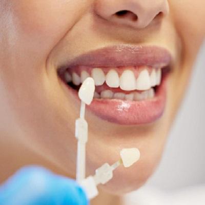 Can Porcelain Veneers Stain