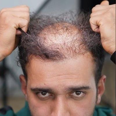 Can transplanataion be done with other person's hair
