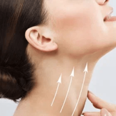 Does Fat Return After Neck Liposuction-