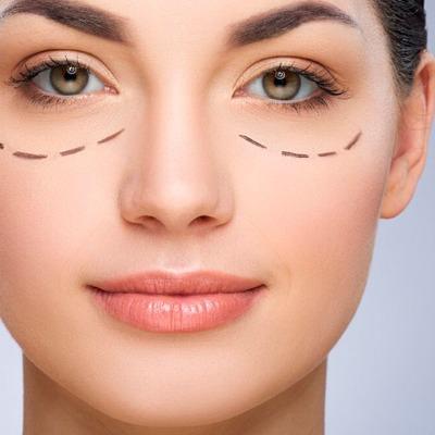 How soon does under-eye filler swelling go away
