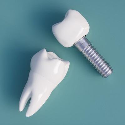 Is pinhole surgery permanent