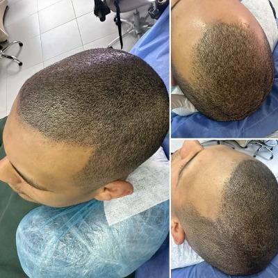 What are the rules after a hair transplant