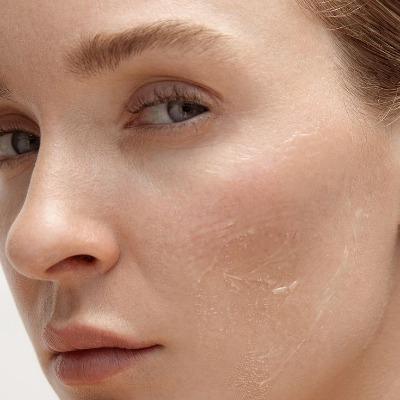 What happens if you don't take care of dry skin