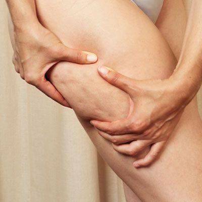 What is the best Cellulite Removal Treatment in Islamabad