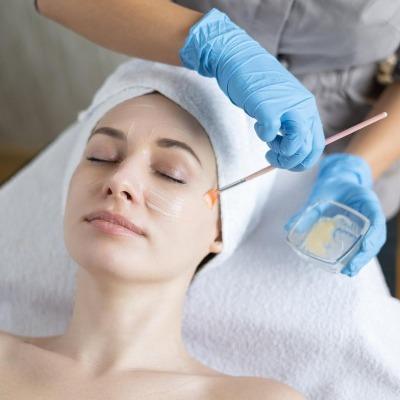 What occurs after a chemical peel if you don't peel