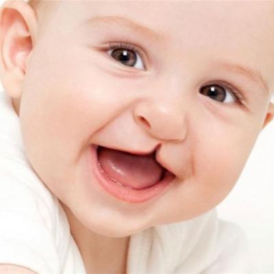 does cleft palate affect speech