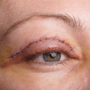 Can eyelid surgery fix droopy eyes