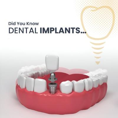 Dental implant in islamabad