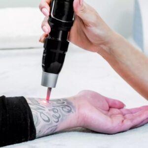 How long does it take to see results from tattoo removal in Islamabad