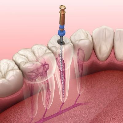 Is It Better to Get a Root Canal or Remove the Tooth