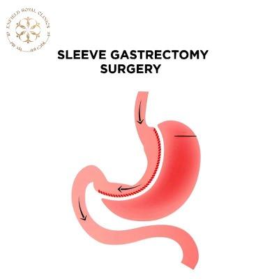 Sleeve Gastrectomy in Islamabad