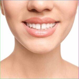 What Is the Best Treatment for Overlapping Teeth