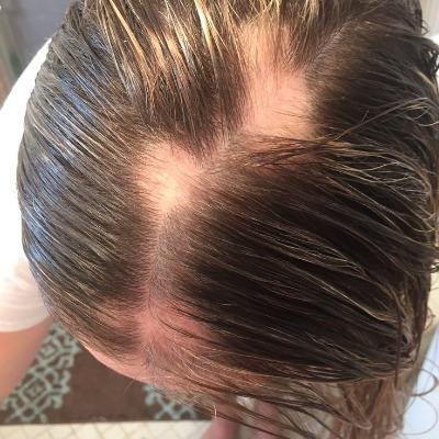 What are the early signs of alopecia areata
