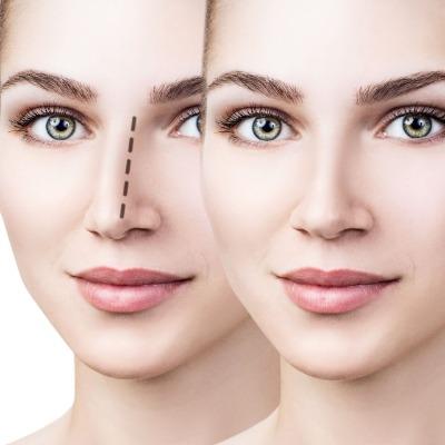 Why is Islamabad becoming a hub for rhinoplasty in Pakistan