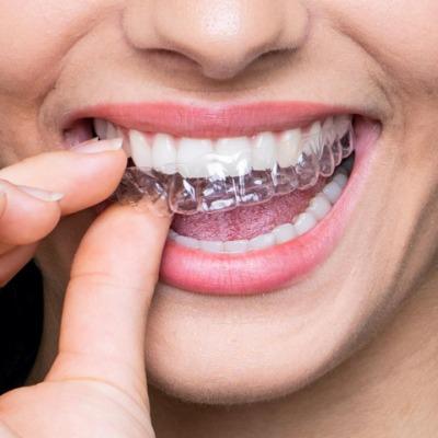 Are Invisible Braces in Islamabad Better Than Metal Braces