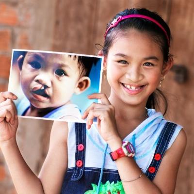 Can Cleft Surgery Be Done in Stages in Islamabad