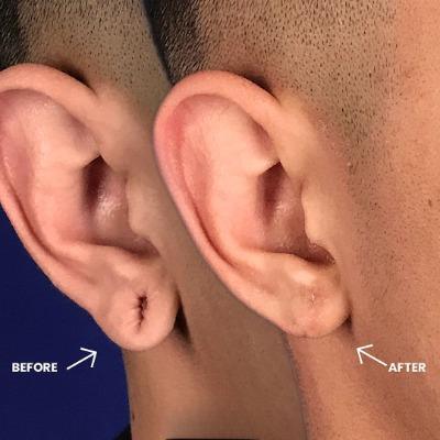 Can Damaged Earlobes Be Fixed in One Session