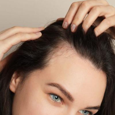 Can Exosome Hair Therapy Help with Receding Hairlines