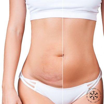 Fat Reduction Treatment in Islamabad