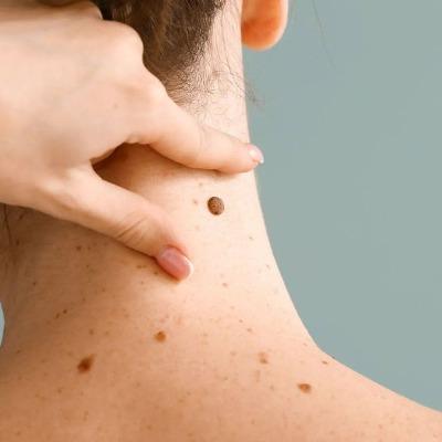 How do experts remove warts safely and gently in Islamabad
