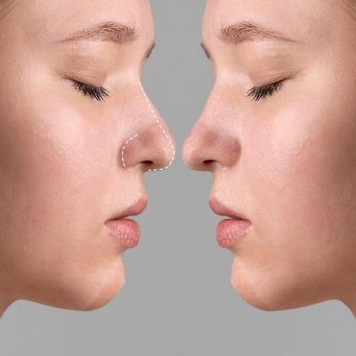 Is There a Risk-Free Nose Reshaping Option in Islamabad
