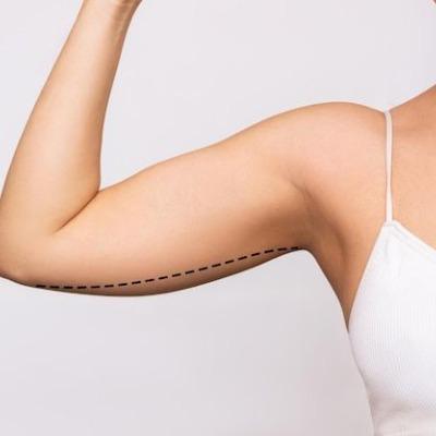 What Are the Risks of Having an Arm Lift