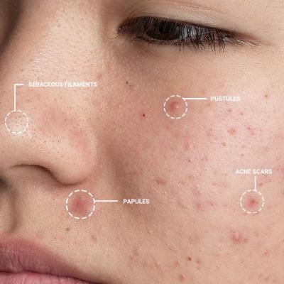 Where to Get Safe Pimple Treatment in Islamabad
