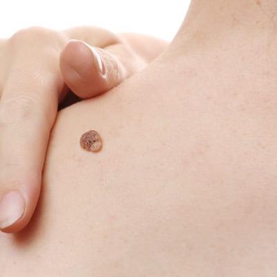 Cost of Genital Wart Removal in Islamabad