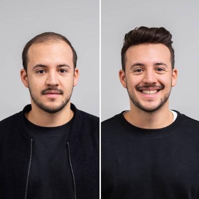 Hair Transplant with Natural Results in Islamabad