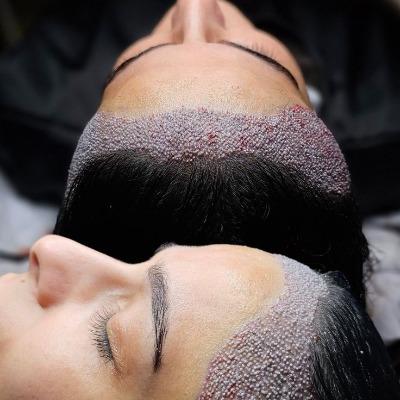How much do 2000 grafts cost in Islamabad