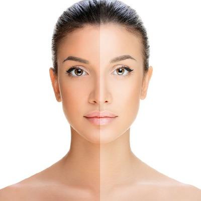 Is Skin Tan Removal Different for Oily Skin in Islamabad